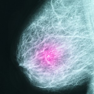 mammogram_lg